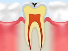 C1：エナメル質の虫歯