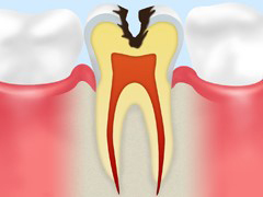 C2：象牙質の虫歯