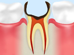 C4：歯根まで進行した虫歯