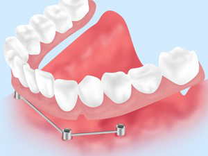 ピタッと動かない入れ歯（下あご用ミニインプラント）