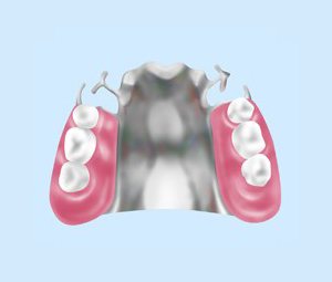 薄型タイプの入れ歯（金属床）
