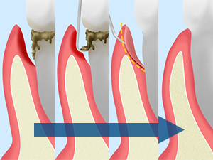 歯周ポケット掻爬（そうは）術
