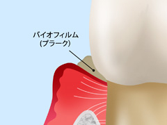 歯肉炎・軽度歯周炎