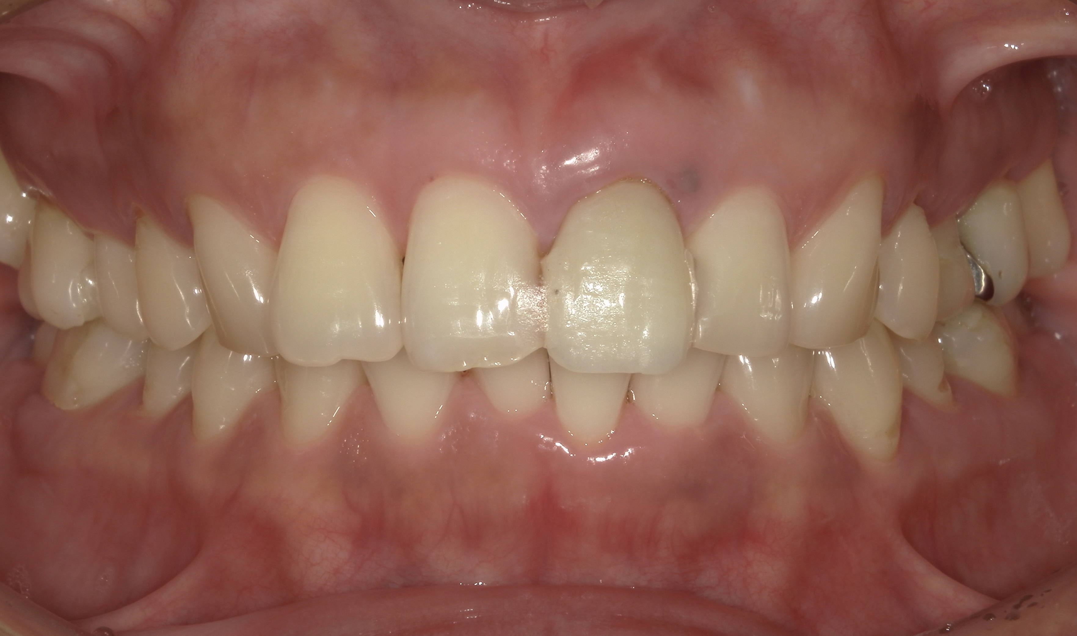 まるで自分の歯のような仕上がり!ジルコニアセラミックブリッジによる前歯の審美治療