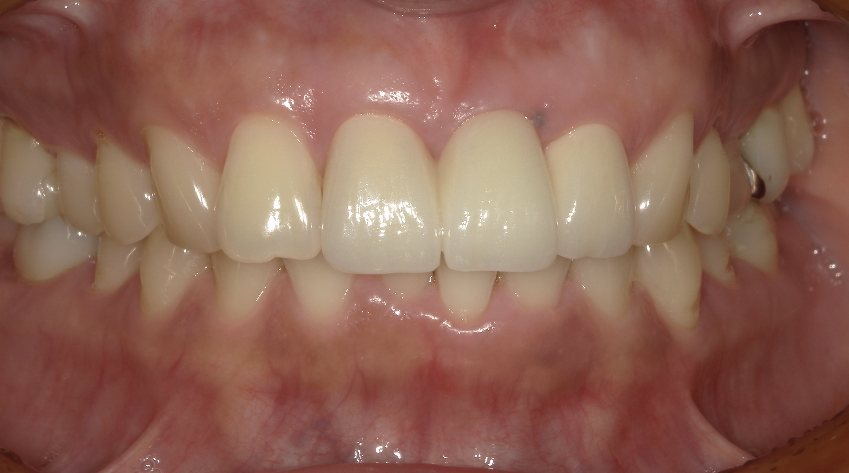 まるで自分の歯のような仕上がり!ジルコニアセラミックブリッジによる前歯の審美治療