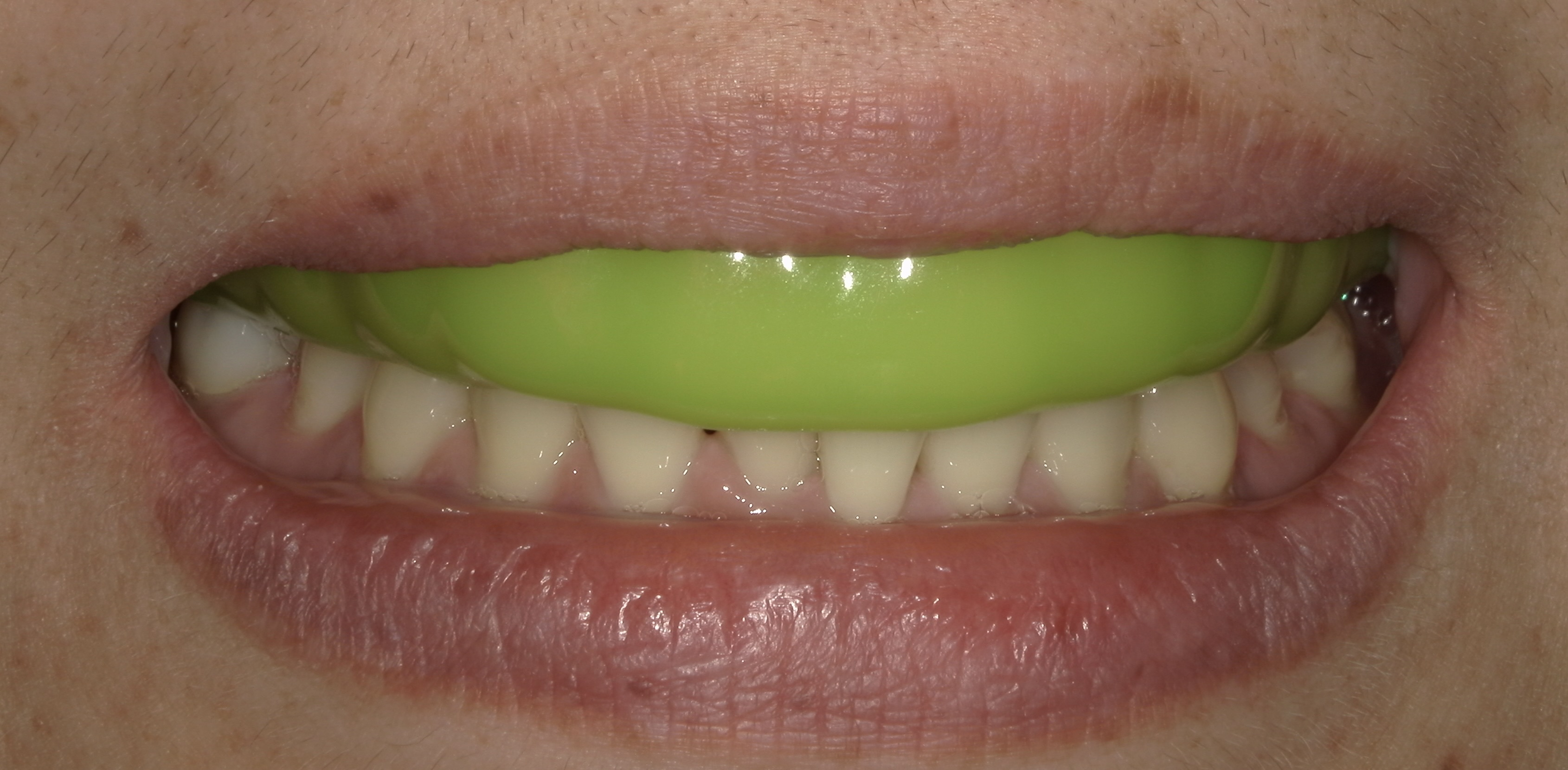 スポーツ用マウスピースで安心・安全なスポーツライフをサポート